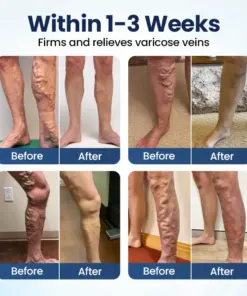 Timilk® Deep Vein Repair Microneedle Patch