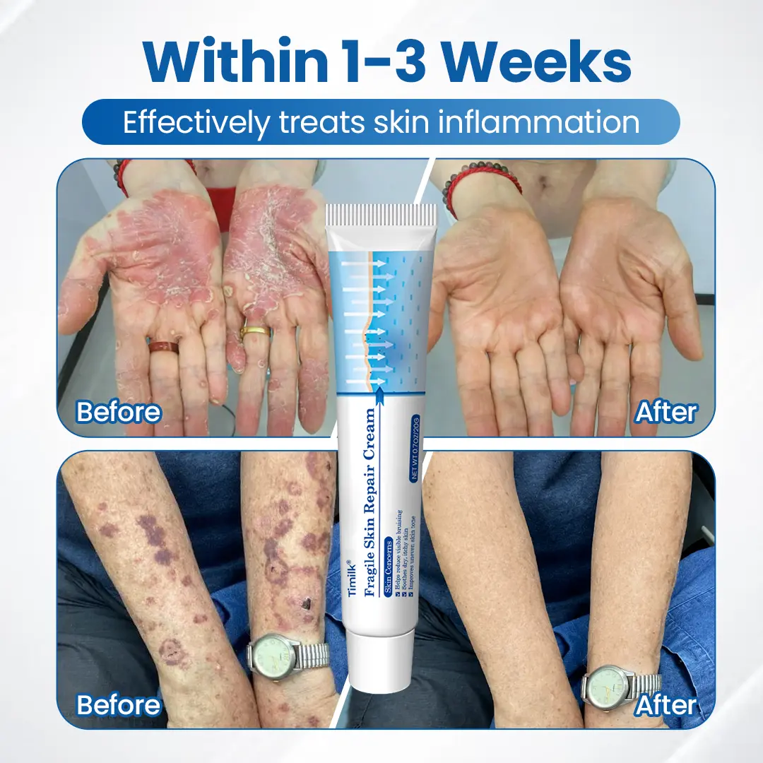Timilk® Fragile Skin Repair Cream