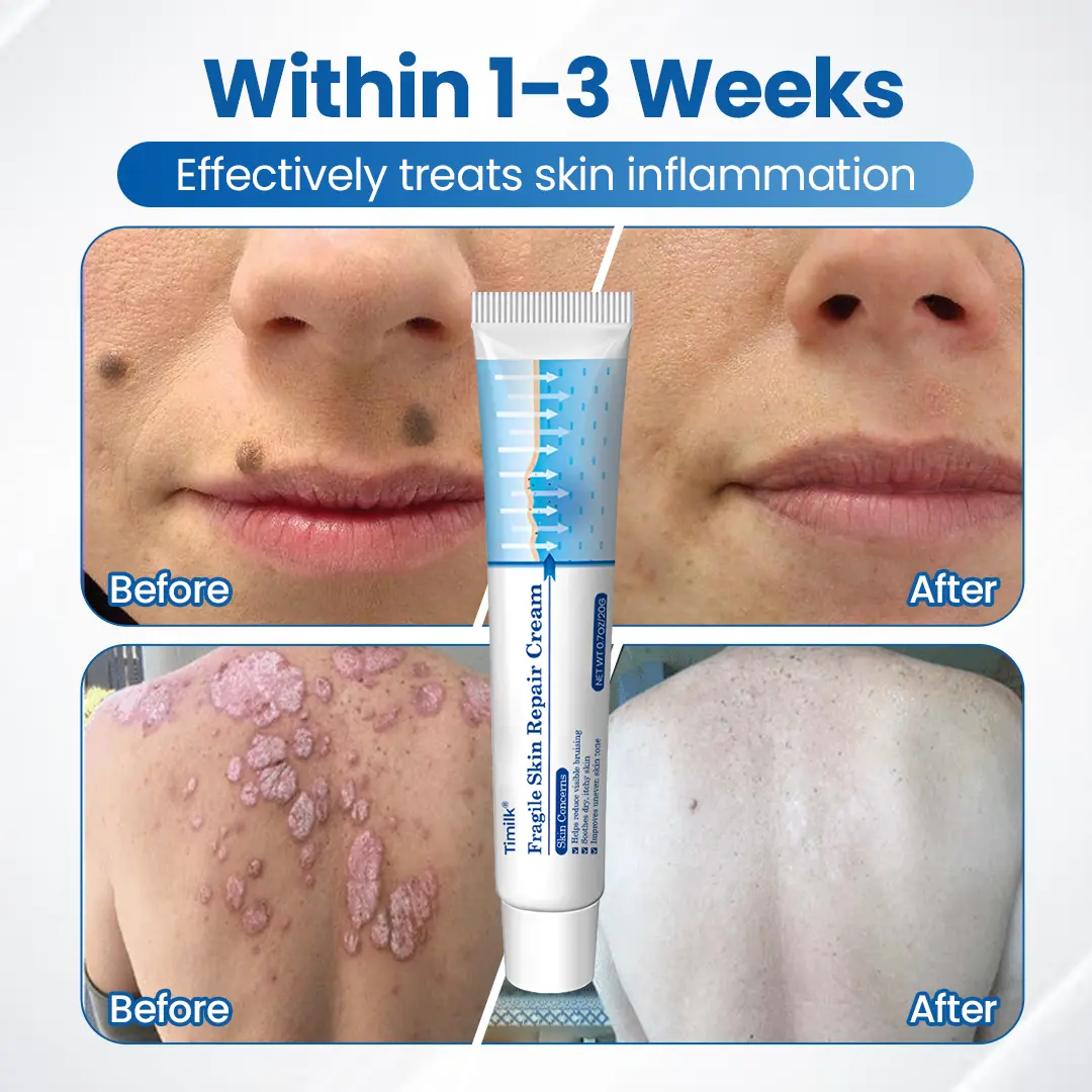 Timilk® Fragile Skin Repair Cream