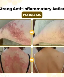 Timilk® PsoriaSoothe Bee Venom Skin-Restoration Cream