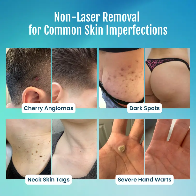 Timilk® SpotlessPro 7-Day Advanced Blemish & Tag Eraser