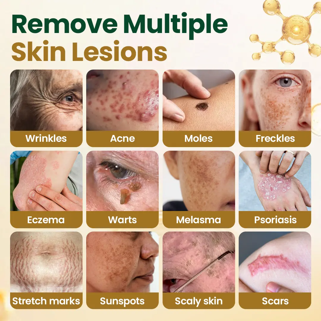 Timilk® Wart Remover Cream