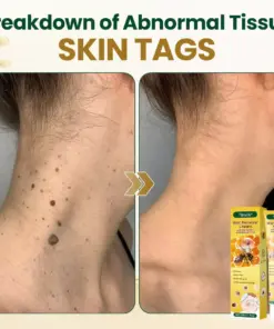 Timilk® Wart Remover Cream