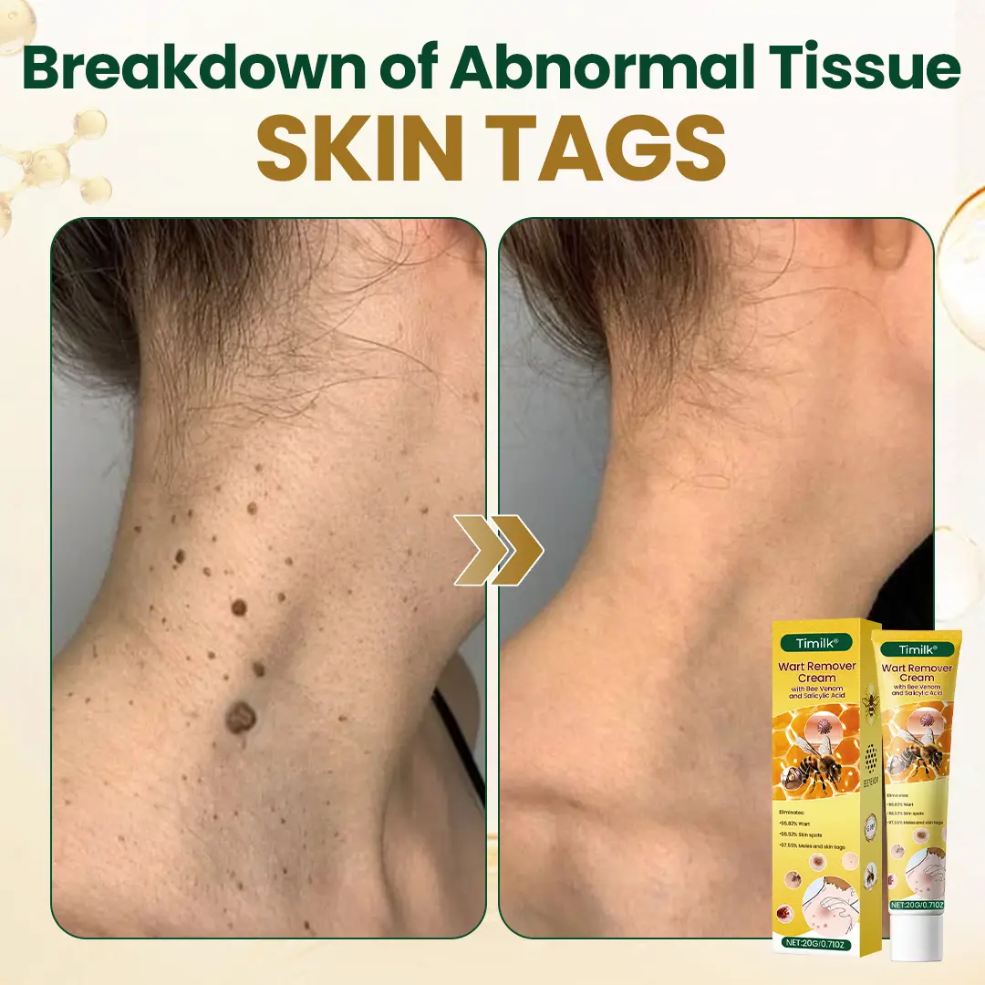 Timilk® Wart Remover Cream