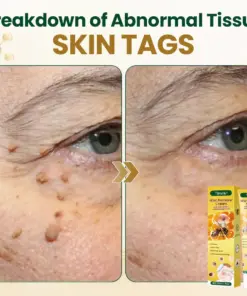 Timilk® Wart Remover Cream