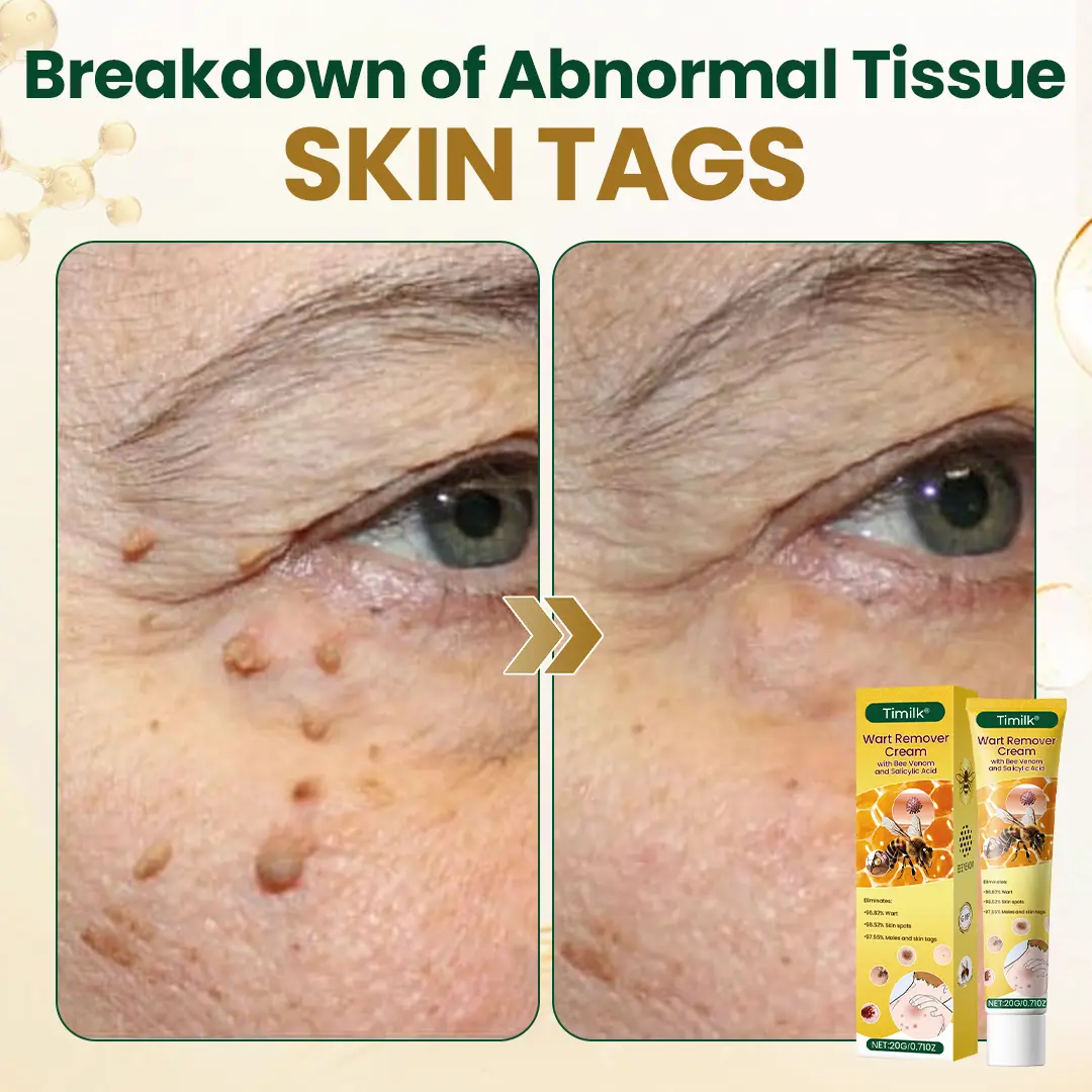 Timilk® Wart Remover Cream