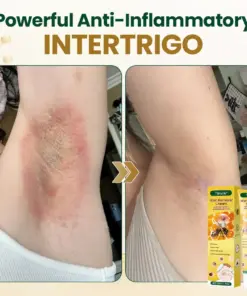Timilk® Wart Remover Cream