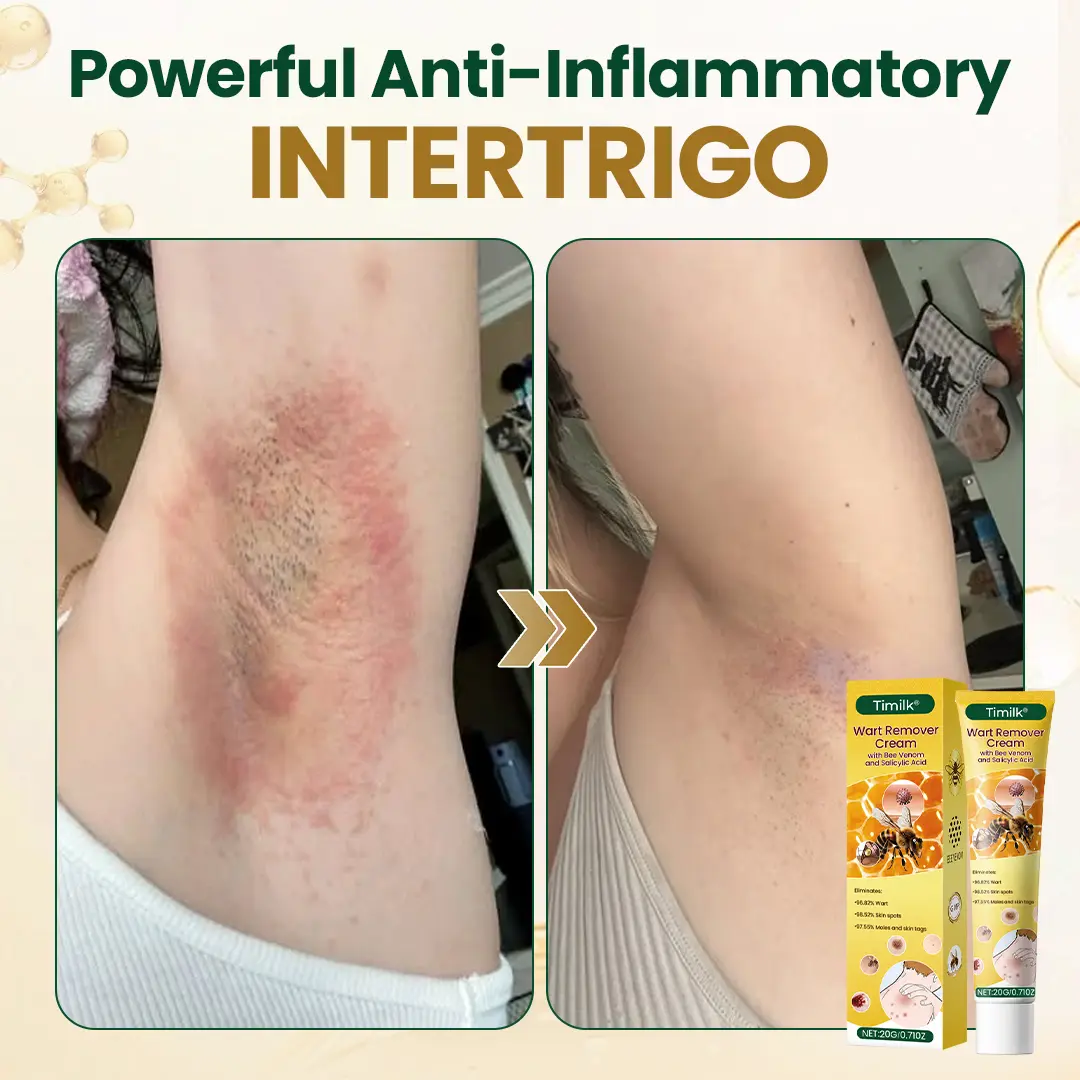 Timilk® Wart Remover Cream