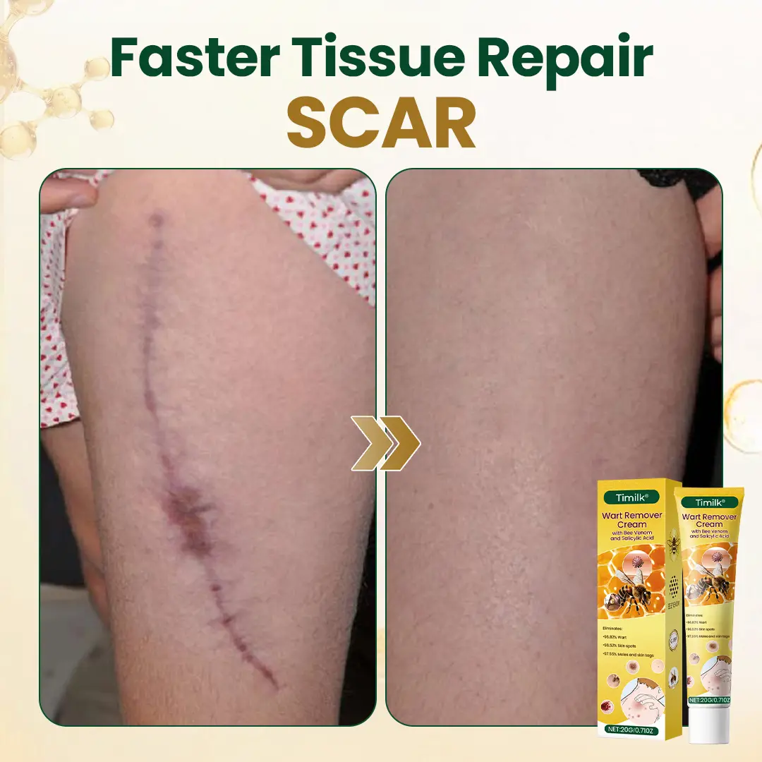 Timilk® Wart Remover Cream