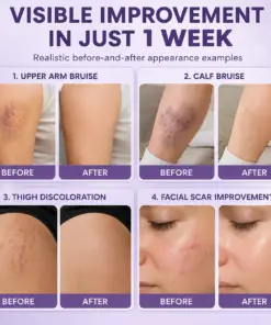 Timilk® BruiseFade Pro Skin Repair Cream