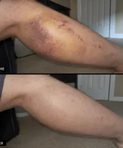 Timilk® BruiseFade Pro Skin Repair Cream
