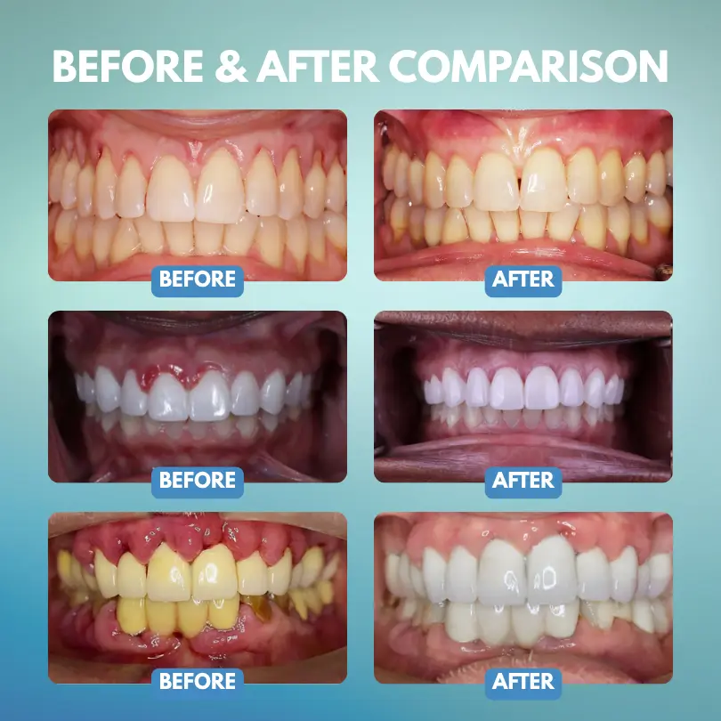 Timilk® GumRescue Precision Gel