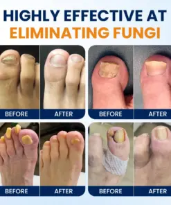 Timilk® Nail Fungus Relief Spray