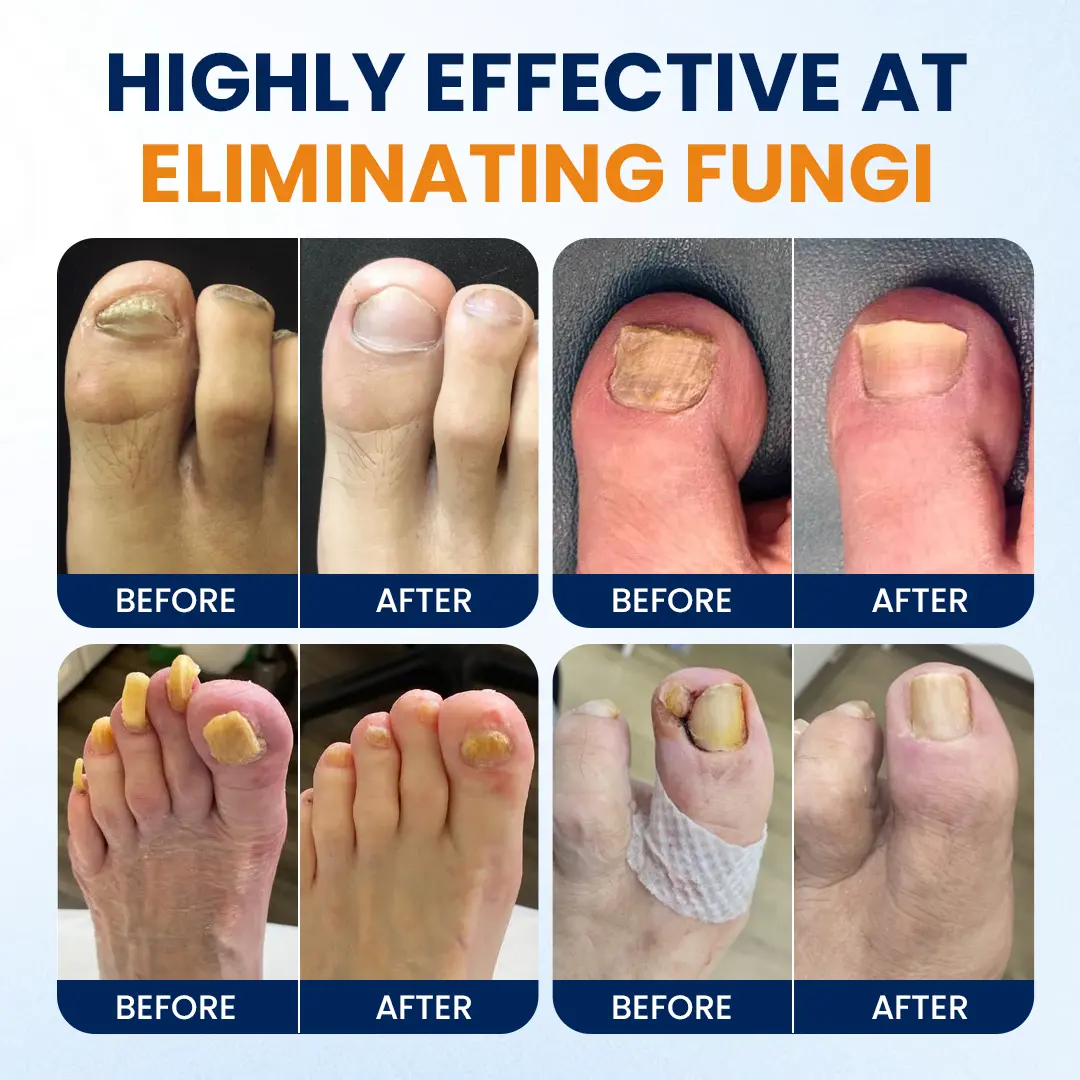 Timilk® Nail Fungus Relief Spray