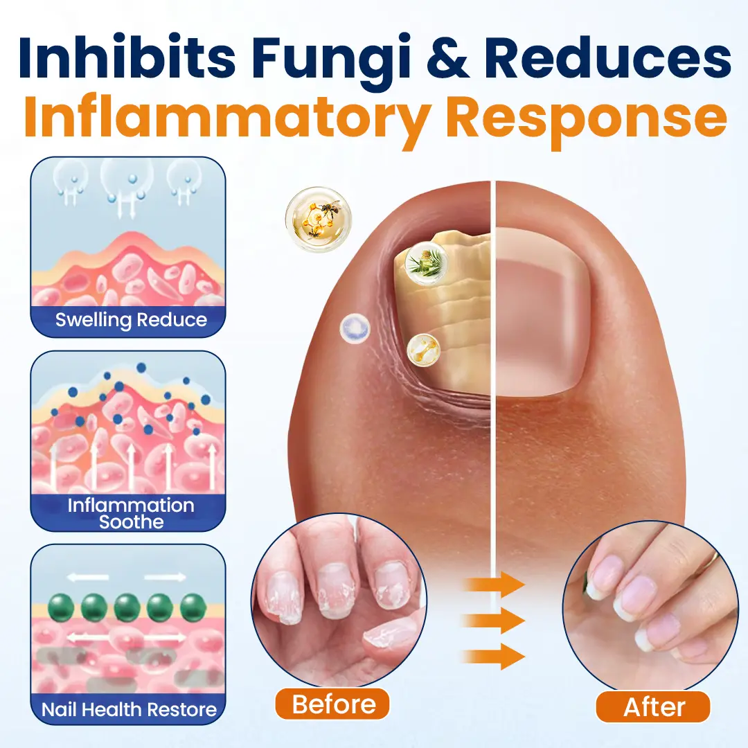Timilk® Nail Fungus Relief Spray