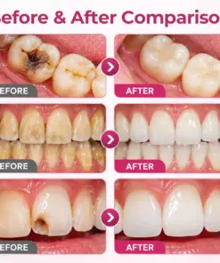 Timilk® DenPerm Cavity-Repair Natural Enamel Filling Gel