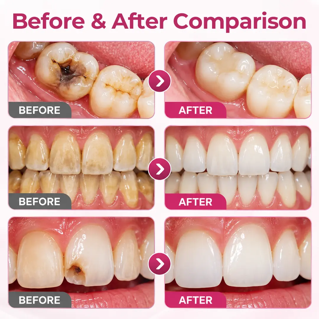Timilk® DenPerm Cavity-Repair Natural Enamel Filling Gel