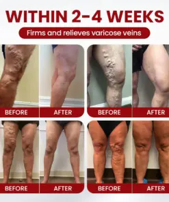 Timilk® Varicose Veins Cream