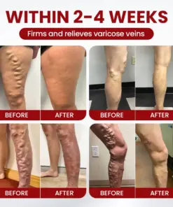 Timilk® Varicose Veins Cream