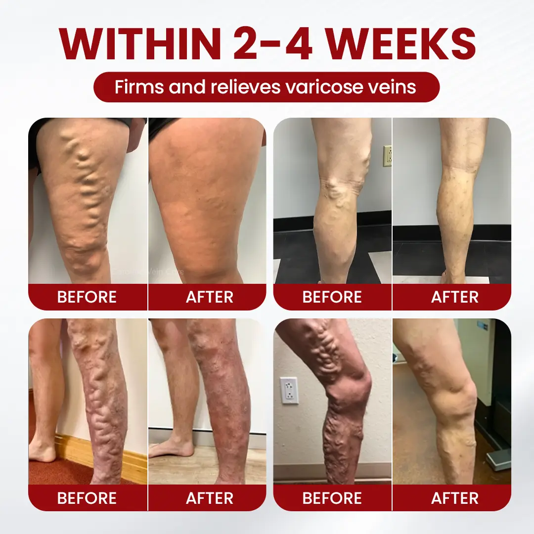 Timilk® Varicose Veins Cream