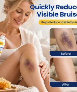 Timilk® VenoRescue Bee Venom Bruise & Skin Recovery Spray